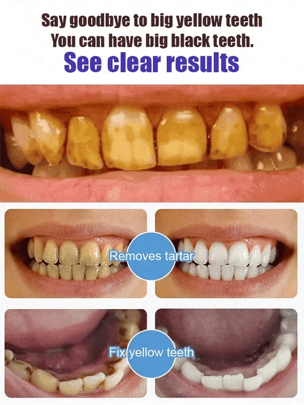 Yayashi SP4 Probiotic Whitening Toothpaste 120g β Removes Coffee, Tea & Smoking Stains + Free Delivery!